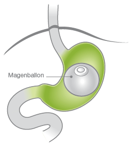 magen mit magenballon