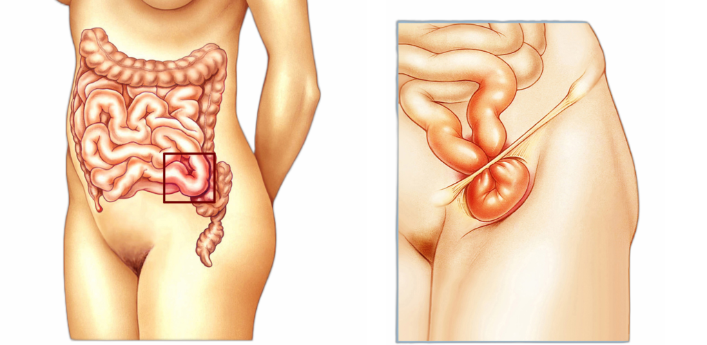 Leistenbruch Abbildung Frauenkörper