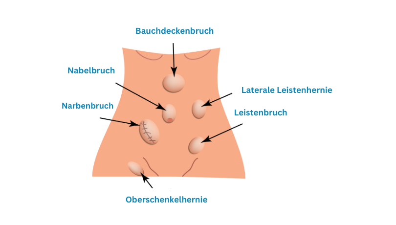 Hernienarten gezeigt an einem 2d-modellierten Körper