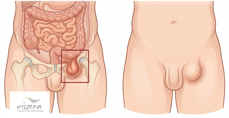 Leistenbruch beim Mann: Anatomie mit Darmschlinge im Leistenkanal und sichtbare Vorwölbung in der Leistenregion