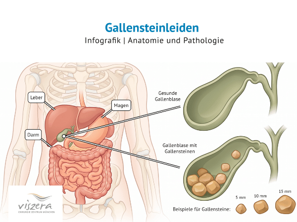 Schematische Darstellung der Gallenblase mit Gallensteinen