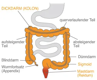 Darmerkrankungen Colitis ulcerosa morbus crohn